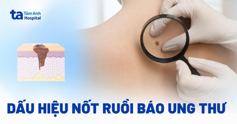 Hinh anh can canh mot not ruoi tren vung co tay nguoi